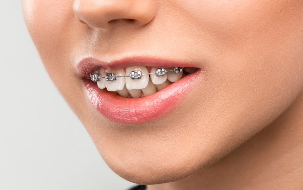 Choosing Invisalign Over Traditional Braces: What Mississauga Residents Need to Know