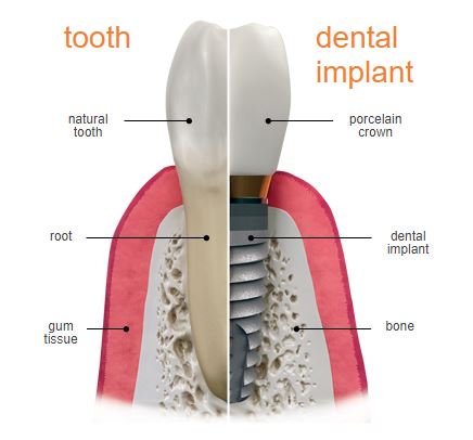 bio-dental-implant