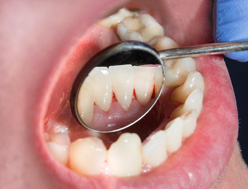 Plaque of the patient, stone. Dentistry treatment of dental plaq