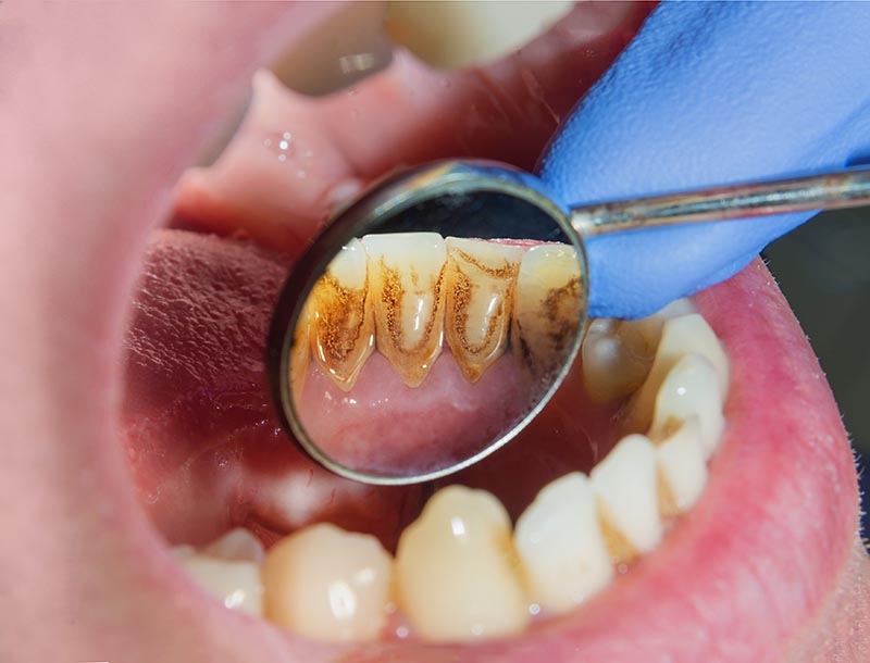 Plaque of the patient, stone. Dentistry treatment of dental plaq