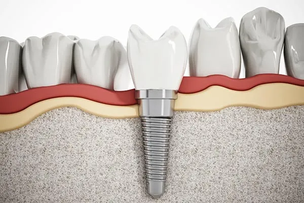 dental-implants-f-1