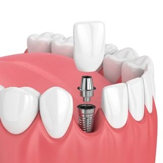 img-implant