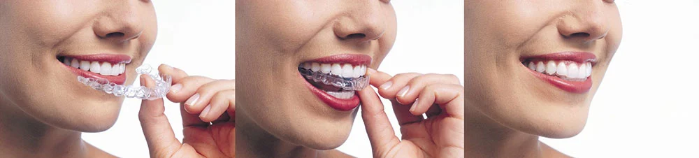 invisalign-2