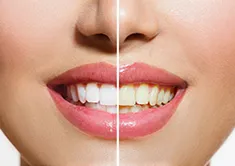 teeth-whitening